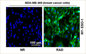 Breast cancer cells