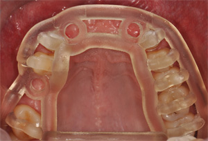 Bohrschablonen für präzisere Zahnimplantation