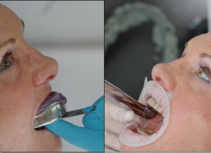 Abformung von Zähnen früher und heute