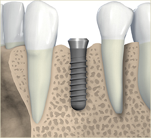 Implantat im Kieferknochen