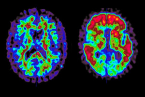 Aufnahme eines Patienten mit Amyloid-PET-Bildgebung